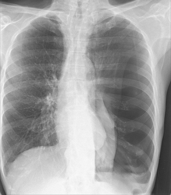 Pneumothorax Xray